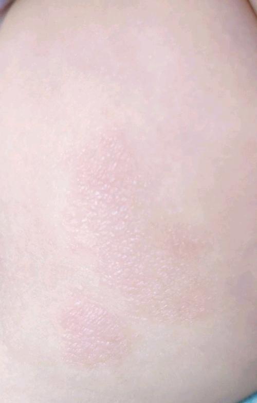 这就是干性湿疹!