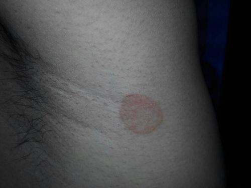 左右胳膊下面各长期一个圆形的红色的斑块,这是什么,不懂的别乱说