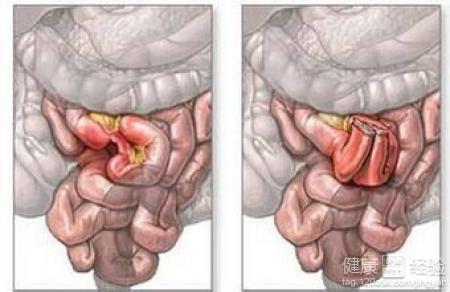 肠梗阻如何灌肠