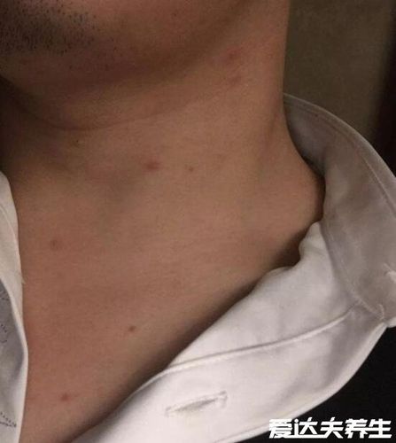 艾滋皮肤初期症状图片多为略微凸起的红点且反复发作