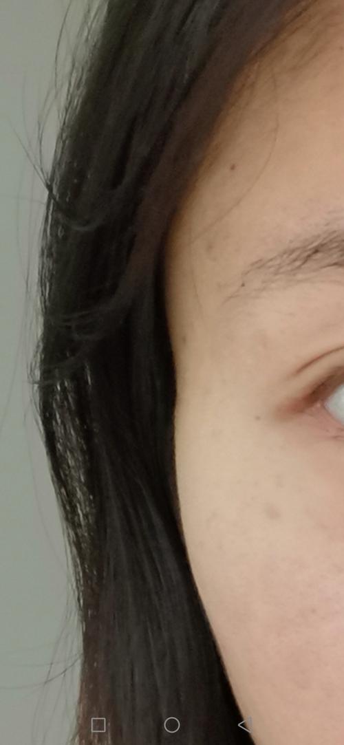 戴眼镜导致的太阳穴凹陷能恢复吗