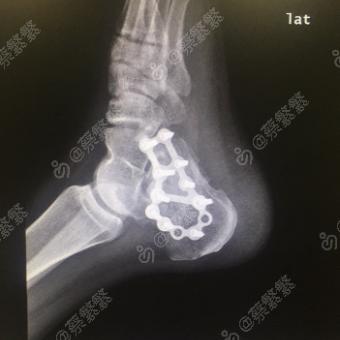 左跟骨粉碎性骨折