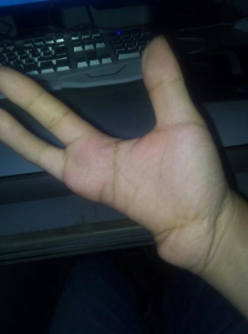 我是一名右手缺2手指请问可以考驾照吗?我运动功能正常!