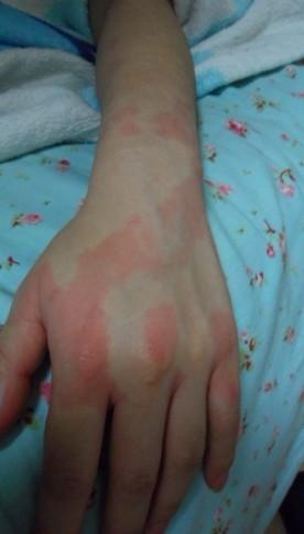 我小妹经常喝酒,喝多了身上就起红斑怎么回事啊?