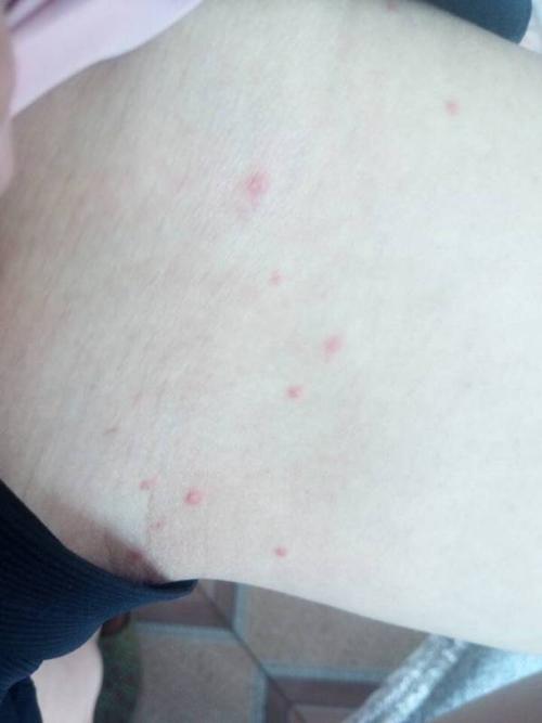 女生,24岁,前几天大腿根部内测起了几颗散在分布的小红点点,特别痒