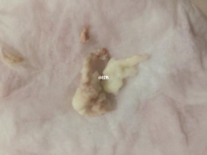 一支就排出宫颈糜烂的腐肉_宫颈糜烂_成都自由行