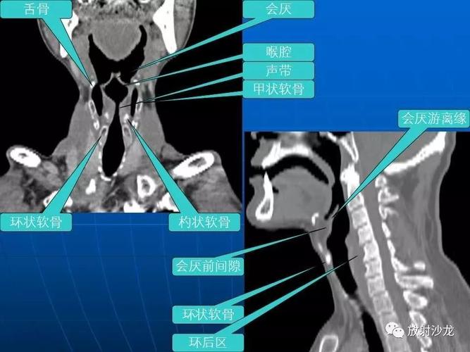 喉癌的ctmri诊断 精品课件必读