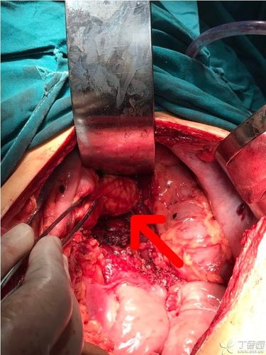 未拍术中囊肿图片,囊液为淡黄色,术中减压后分离囊肿直至胰腺后方