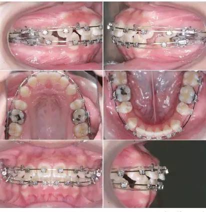 自锁托槽临床应用中的常见误区上