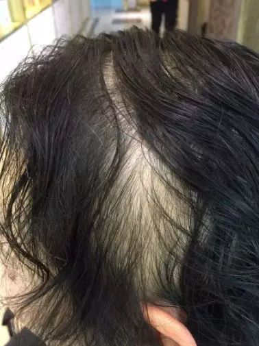 产后脱发 | 为娘要成秃子了吗?戳进来有科学的解决方法!