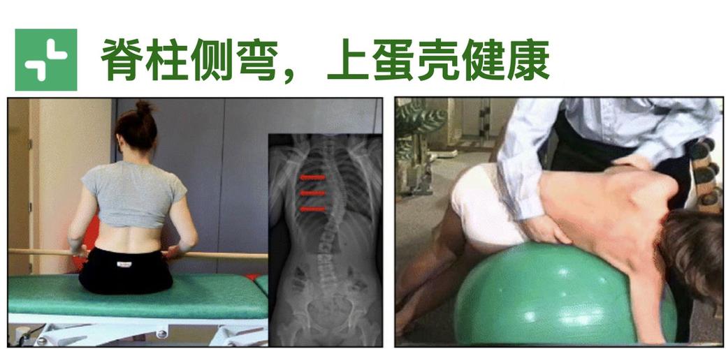 如何运动康复纠正脊柱侧弯
