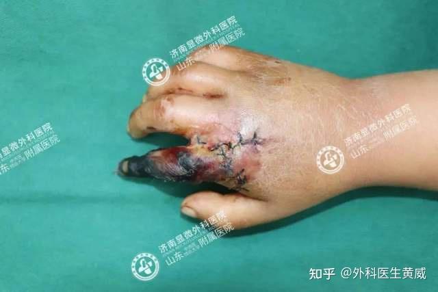 为什么很多人都选择"3d全形手指再造术"复原缺损手指?