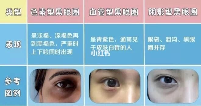 眼袋手术淡化阴影型黑眼圈,案例217