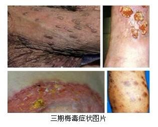 梅毒的早期症状