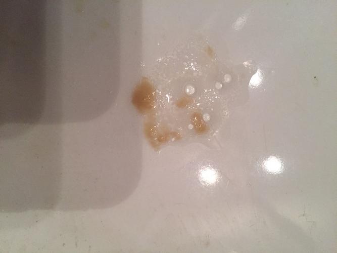 急:这种痰属于什么病症?