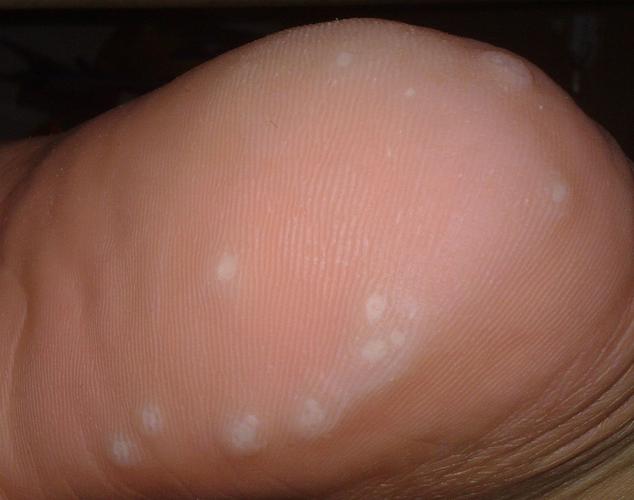 脚后跟长了白色的小疙瘩,按着有点疼但不痒