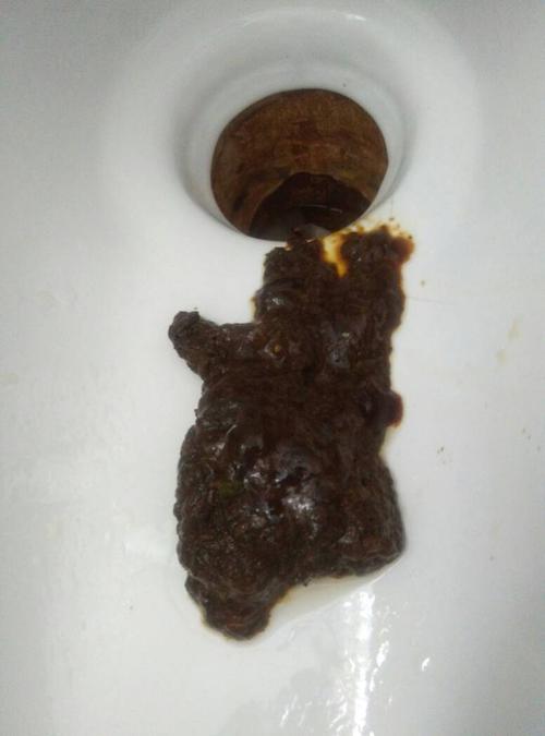 还会肋部和肋部直对后背隐隐作痛,最近大便总是深色,不知道是不是血便