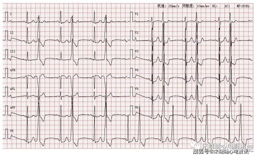 室性早搏二联律 3.左心室高电压 4.