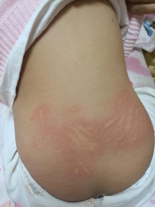 宝宝近三天来一直拉肚子,今天拉肚症状好转,但是发现皮肤不定时出现