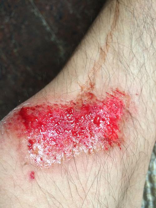 刚刚开车遇到狗在沙子刹车摔倒,现在膝盖旁边擦出血了,血好像油油的