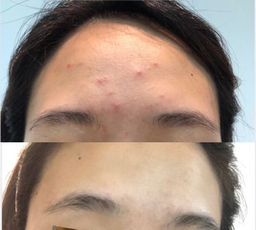 一张让我震惊的对比照,祛痘前后反差好大!