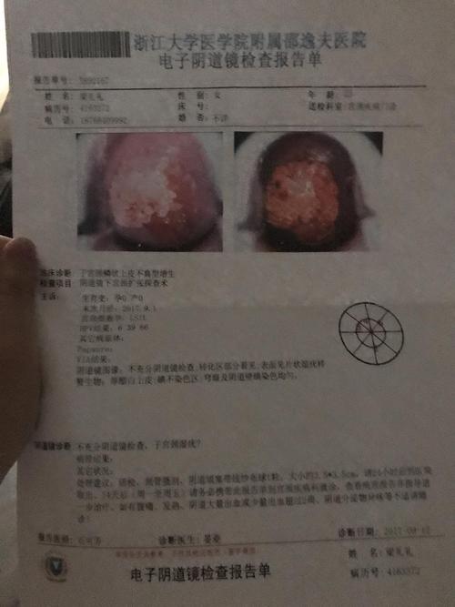宫颈湿疣四个月显示转阴
