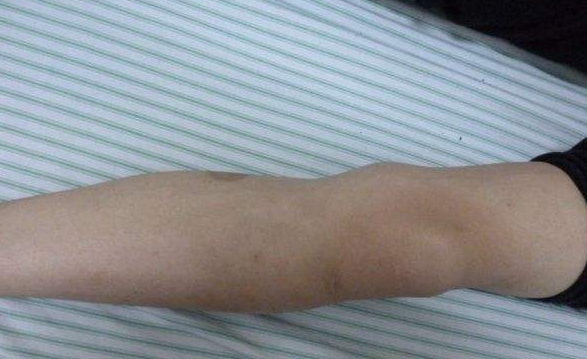 骨肉瘤大概多久能治好