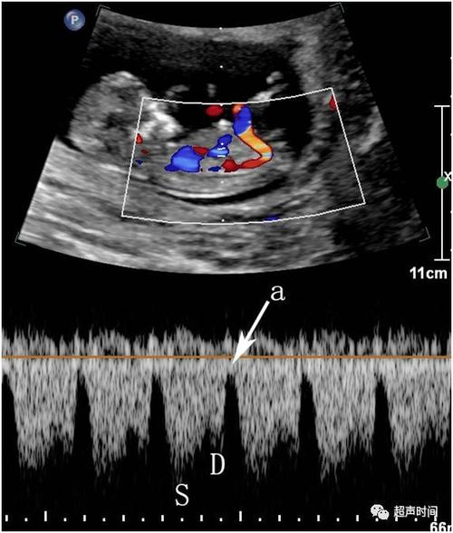 孕早期超声扫查规范(fmf 版):静脉导管血流