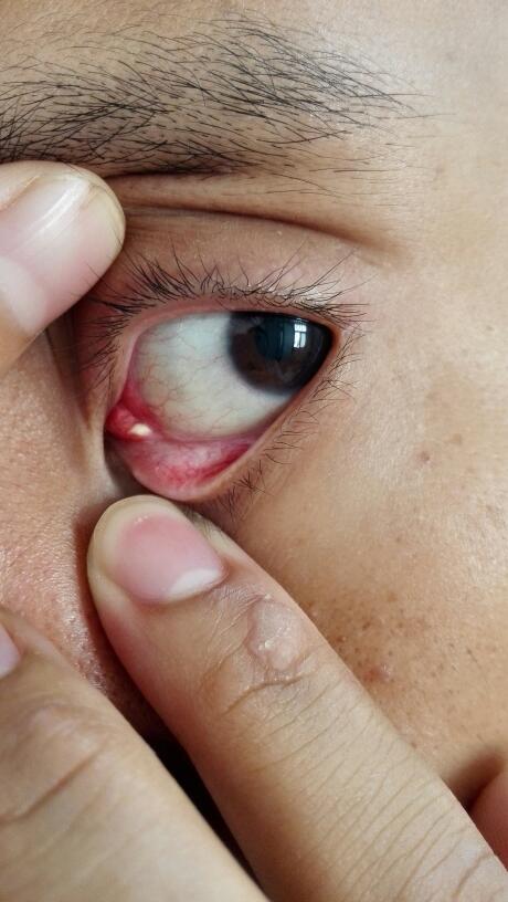 眼里长了个白色的痘痘,请问这是什么