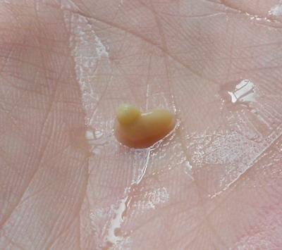 认识扁桃体结石