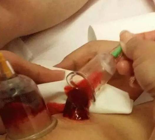 中医说泻淤血治百病