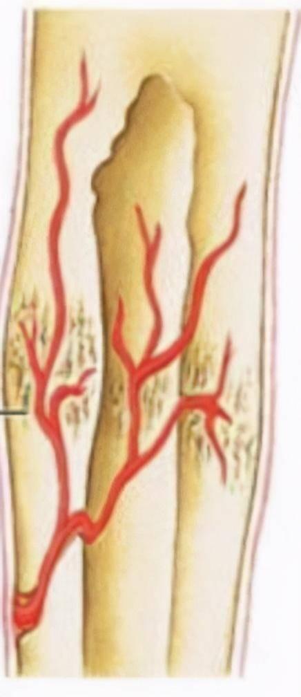 原始骨痂形成期