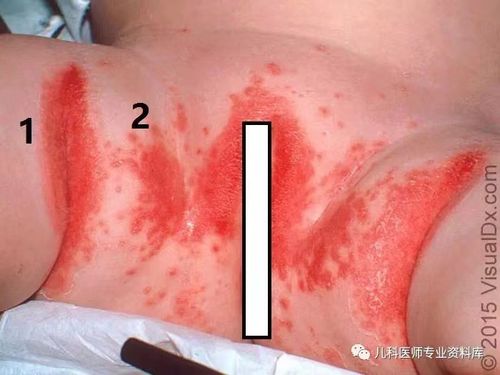 宝宝红屁股(尿布疹)那家长们能怎么办呢?