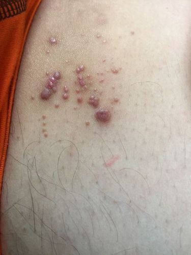 请问大腿内侧张了黑黑的痘痘不疼不痒的,是什么