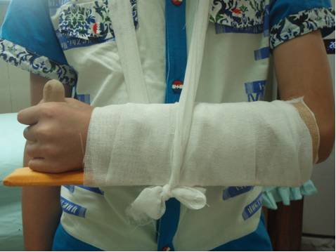 中医正骨就是这么神奇——部分骨折中医正骨前后照片对比(第三期)