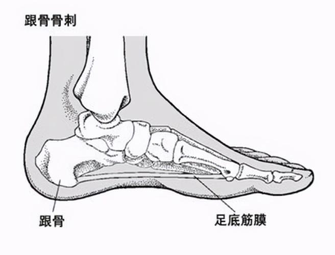 无侧方挤压痛 伴或不伴跟骨底面骨刺, x-ray示骨小梁排列清晰 mri见