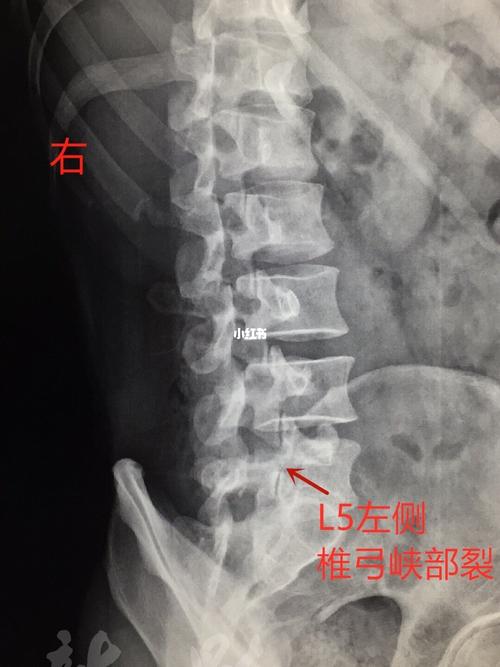 腰椎_腰疼_医疗健康_医疗健康其他