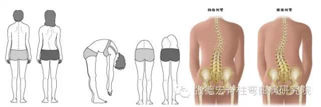 魏希克教您一分钟及时发现孩子脊柱侧弯问题