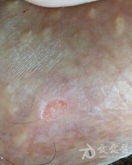 生殖器皮肤溃疡,就不愈合