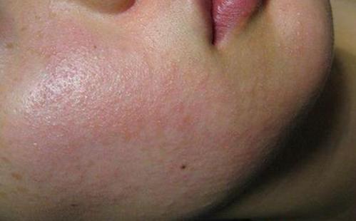 脸上过敏了怎么办?