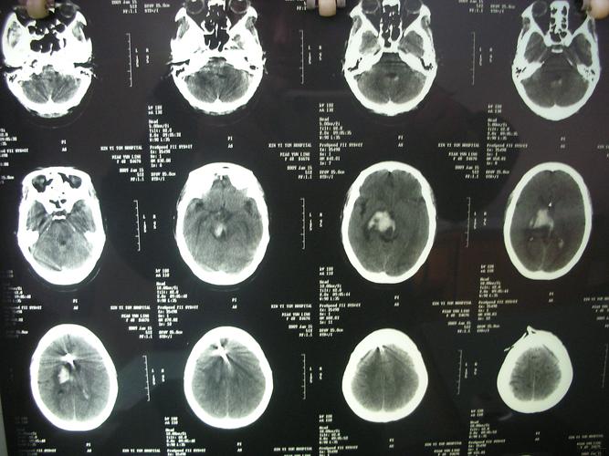 查体:bp:120|70mmhg,昏迷,压眶反射存在,双侧瞳孔不圆,直径约5.