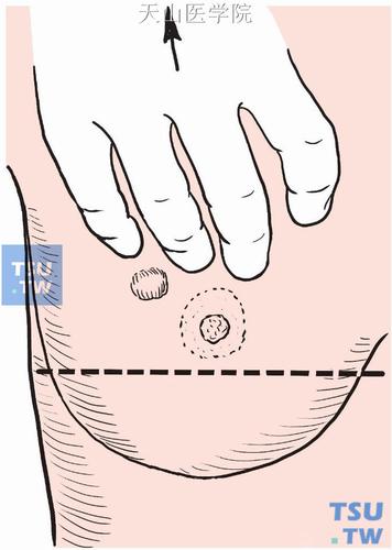 拟定切口时,可先将乳房尽量上提,沿乳晕下方画一水平线 _外科手术学