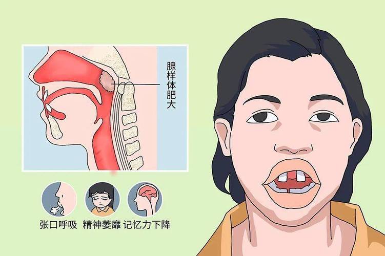 慢慢变丑!是腺样体肥大在作怪?