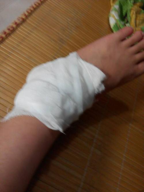 我是高三生 还有三天就要高考了 可是今天中午我的脚崴到了 刚崴到时