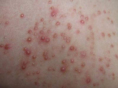 毛囊炎的全身症状表现