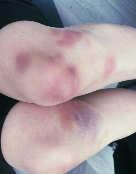 > 正文 1905片子网讯 2月20日,在微博发布搞怪照片一组腿部淤青的照片