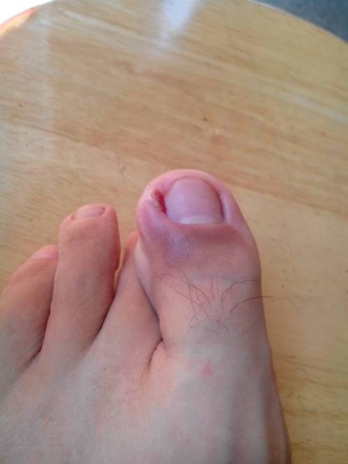 大脚趾甲沟炎图片39