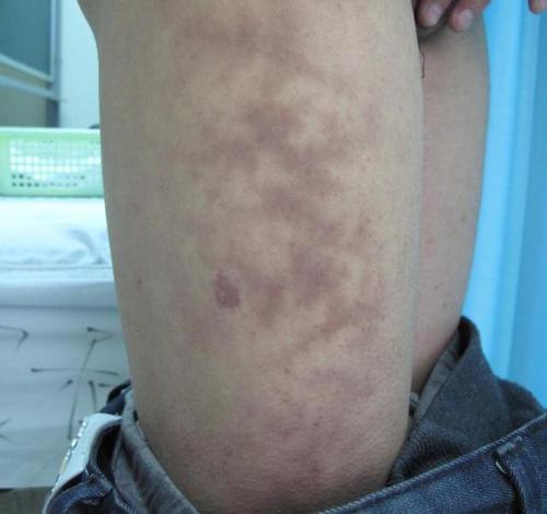 火激红斑最典型的特征就是局限性的网状红斑和色素沉着;通常不疼不痒