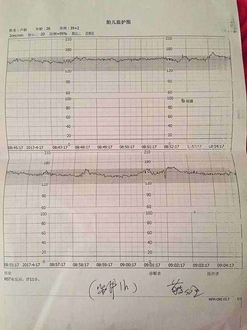 胎心监护总分多少算正常 胎心监测总分的多少分为标准