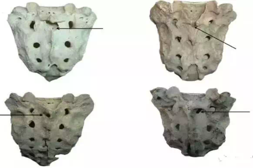 骶骨—常见的解剖变异(图文并茂)